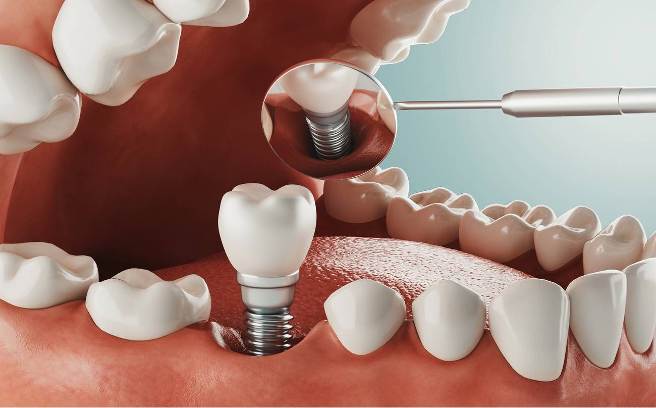 Dentist Supports